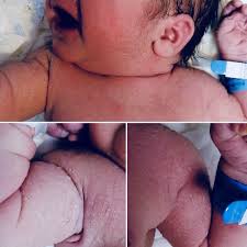The word comes from the latin desquamare meaning to scrape the. Sprinkled Water Drops On The Skin In Newborns Congenital Miliaria Crystallina Adc Fetal Neonatal Edition