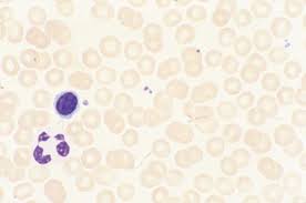 This is a trashy smear, but it does show an extremely advanced case of the microcytic/hypochromic anemia characteristic of iron deficiency. Evaluation Of Anemia Hematology And Oncology Msd Manual Professional Edition