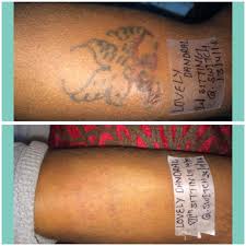 Laser tattoo removal requires a series of treatments, meaning clients will need more than one procedure to see results. Laser Tattoo Removal Posts Facebook