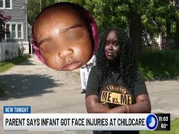 Mom wants answers after picking up her baby from childcare with black eye  and scratches