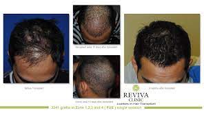 Hair Transplants Results Before And After At Reviva Clinic Http Revivaclinic Com Hair Transplant Hair Transplant Results Hairfall Treatment Hair Transplant