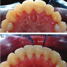 Our powerful toothpaste collection helps reverse early gum damage. Glass Fibre Reinforced Bonded Orthodontic Retainer In The Upper A And Download Scientific Diagram