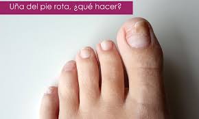 Una Del Pie Rota O Desprendida Que Hacer