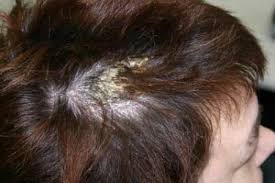 Also known as tinea amiantacea, pityriasis amiantacea is a distinct scalp disorder, usually there are different causes of pityriasis amiantacea and it is important to avail treatment of pityriasis. Pityriasis Amiantacea Dermateam