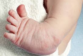Maybe you would like to learn more about one of these? Can Clubfoot Be Fixed