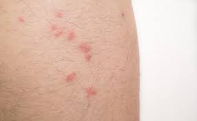 A health threat to both pets and their humans. How To Identify Common Bug Bites