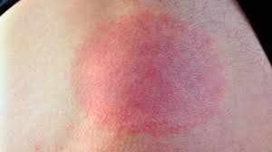 Zeckenbiss Wanderrote Weist Auf Borreliose Hin