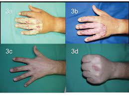 We did not find results for: What Do 1st 2nd And 3rd Degree Burns Look Like A Visual Guide Allure