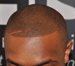 Below, we'll talk about how you can cover thin. A Great Hair Loss Treatment For Black Men His Hair Clinic