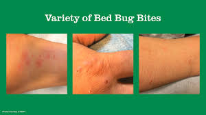 Image result for bedbugs bites