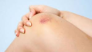 Vucutta Meydana Gelen Morluklar Nasil Daha Hizli Iyilesir Hangi Durumlarda Morluklar Icin Endiselenmek Gerekir