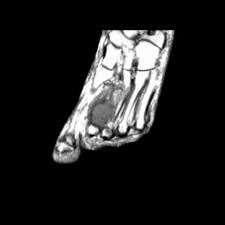 See full list on cancer.org Tumors Of Foot And Ankle Musculoskeletal Key