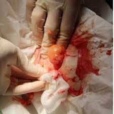 Episacral Lipomas Physiopedia