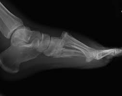 It can occur in one or both feet. Lisfranc Injury Foot Ankle Orthobullets