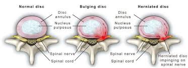Check spelling or type a new query. Herniated Disc Should I Be Afraid