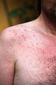 Es handelt sich wirklich um akne. Acne Aestivalis Ursachen Symptome Behandlung Medlexi De