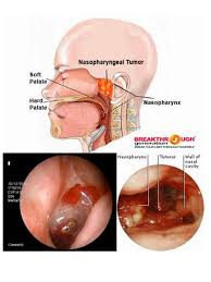 Manfaatnya sudah di buktikan oleh konsumen yang menderita kanker stadium lanjut,kemudian mengkonsumsi ziirzax&typhogelk dari denature alhamdulilah berangsur sembuh tanpa. Mengenal Kanker Nasofaring Penyakit Khusus Orang Asia Lifestyle Fimela Com