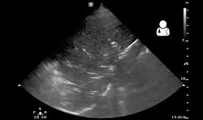 Image result for Air Bronchogram