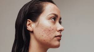 Ready to stop treating the symptoms of acne and begin treating acne at the  source?