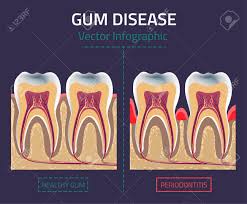 Teeth Infographic Gum Disease Chart