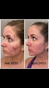 This took me a while to feel comfortable & confident enough to post. I have  struggled with acne for over 20 years & after my Dad passed, the stress  just seemed to seep through my skin. Both pictures ...