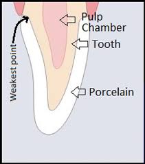 There may be other work involved based on what will happen to the tooth the amount of time will vary based on the location of the tooth in your mouth and how badly it is decayed. Three Reasons A Front Tooth Might Not Need A Crown After Root Canal Treatment Bayou Dental Group