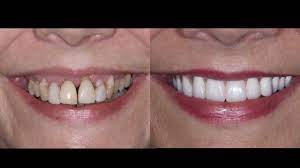 Maybe you would like to learn more about one of these? Can Loose Teeth Be Saved To Pull Or Not To Pull Youtube