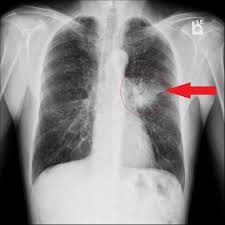Image result for lung cancer xray