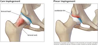 World air sports federation) is the world governing body for air sports, and also. Femoroacetabular Impingement Children S Hospital Colorado