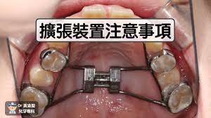 擴弓裝置注意事項– 兒童牙科黃渝聖醫師