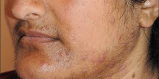 Pcos hairs usually grow on the face, chest, stomach, and back. Polycystic Ovary Syndrome Pcos And Hirsutism Furocyst