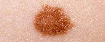 It may grow slowly and it's typically treatable. Skin Cancer Detection Technology Promises Early Diagnosis Myvmc