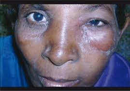 Preseptal cellulitis with spreading facial cellulitis