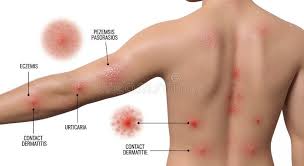 Image result for Varicella zoster on human skin