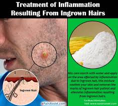 Stop waxing, shaving, or plucking the hair in that area until the ingrown hair goes away. Treating Inflammation Resulting From Ingrown Hairs Easy Ways To Get Rid Of Ingrown Hair