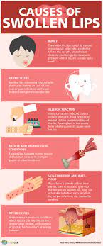 What Are Swollen Lips Causes Treatment 11 Natural Ways Stemjar