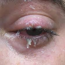 Chemicals get into your eye (in this case, use water only, and keep flushing for 15 to 20 minutes) fill a container or eye cup (you can get eye cups at the drugstore). Saving Your Vision From Super Glue In The Eyes Hackaday