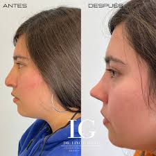 Lino García |Rinoplastia