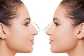 Nose Job surgery in Turkey - Aesthetic Travel