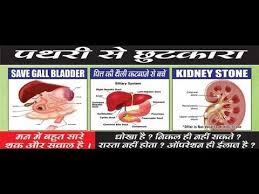 Gall Stone Removal Without Operation With Guarantee Gallstones How To Remove Gallbladder