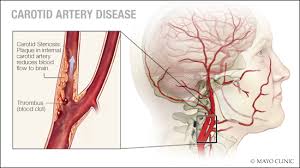 Coronary arteries, the carotid arteries in the neck, and renal (kidney) or biliary (gall bladder) when a person has a stroke it can be from blockage in 1 or both of the carotid arteries in the neck. Carotid Disease Treatment Carotid Artery Blockage Surgery
