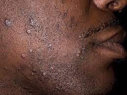 To this pathology, owners of hard and curly curls are more likely. Ingrown Beard Hairs Skin Disorders Msd Manual Consumer Version