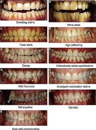 You will put in a request for a home teeth whitening kit. Tooth Whitening Wikipedia