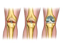 Cost Of Total Knee Replacement Surgery In Delhi India Compare Cost Best Hospitals Lazoi Total Knee Replacement Knee Replacement Knee Surgery