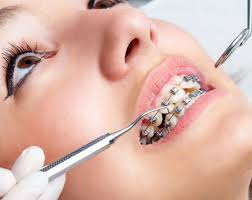 Learn how to use wax on braces. Putting On Braces How Are Braces Put On