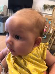 Help. Been refered to GOSH in London but still waiting for appointment. Her  head got better since born. She was breech all the time and born c section.  Do you think is