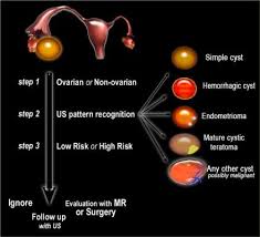 The Radiology Assistant Ovarian Cysts Diagnostic Work And Roadmap Ovarian Cyst Ovarian Cysts