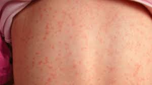 Scharlach wird von bakterien (streptococcus pyogenes bzw. Scharlach Ist Zuruck Und Eltern Mussen Auf Diese Zeichen Und Symptome Aufpassen Yum Rezepte