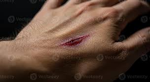 Image result for Hand Injury