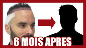 Que mes golfes soient creusés, franchement j'ai l'habitude, pas de soucis, perte de cheveux femme cause puis c'est pas trop laid ! Calvitie Ma Greffe De Cheveux 6 Mois Apres Youtube